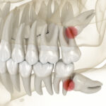 Wisdom tooth impaction