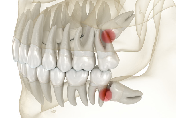 Wisdom tooth impaction